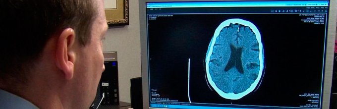 Патологические симптомы, тактика лечения и степени ишемии сосудов головного мозга
