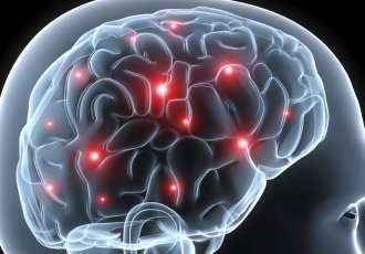 Почему после инсульта длительное головокружение, и что делать в данном случае